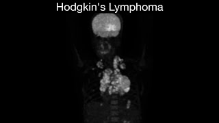 Hodgkin's Lymphoma: