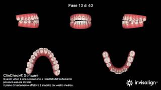 Invisalign occlusale