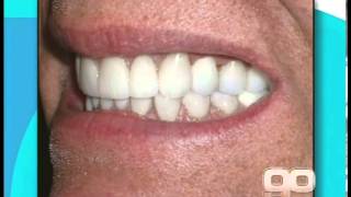 Dental Implants | Cleveland Smiles - Dr. Steve Marsh DDS