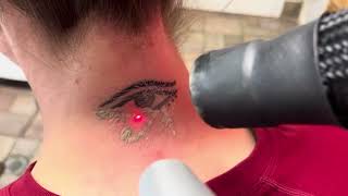 Back of the neck tattoo removal. I’ve got my eye on you !! Laser tattoo removal