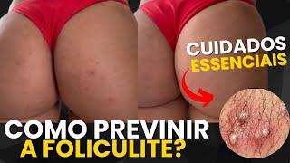 Como prevenir a FOLICULITE: dicas e CUIDADOS ESSENCIAIS