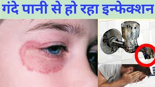 How to avoid Skin fungal infection | Tap cleaner