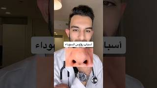 اسباب رؤؤس السوداء