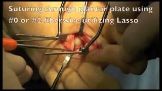 Anatomic Plantar Plate Repair Lasso Technique Arthroscope x264