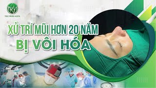 Xử Lý Mũi Hơn 20 Năm Bị Vôi Hóa, Mũi Sline Sửa Lại