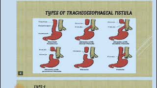 Trachea Esophageal  fistula,Definition,causes,types, clinical manifestations Part-1|Pediatrics|