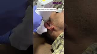 👉 Permanent Ear Hair Removal 👉100% safe ✅️ Painless 👉Guaranteed result