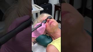 KTP Laser Therapy (Part 2) -  Eugenie Brunner, MD, FACS - Princeton, New Jersey