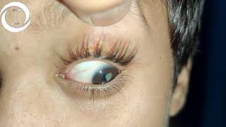 Ophthalmic Signs Cornea