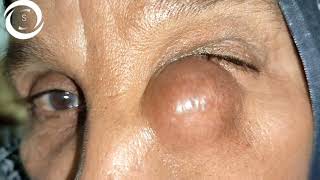 Ophthalmic Signs Adnexa