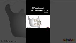 MEAW class II low angle / МПД низкий угол 2 класс