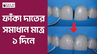 Veneers Treatment ll Tech Dental