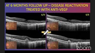 Late Night Retina - Macular Neovascularization - S2 Episode 2