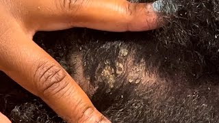 Fast Aggressive Dandruff Scratching | Random Parting | Scalp Check