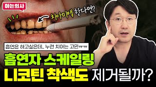 흡연 후 니코틴 착색 스케일링으로 지울 수 있을까? 치아미백으로 지워질까?