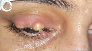 Ophthalmic Signs Eyelids