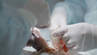 Bloody organ operation. Action. Close-up of two surgeons operating on organ together. Complex