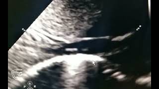 Umbilical venous catheter  tip in the Right atrium demonstrated on subcostal sagittal plane