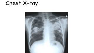 Part4 Mycobacteria