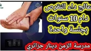 عالج داء النقرص بجلسة واحدة