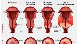 Staging and survival rates for gynaecological cancer I MRCOG Part 2