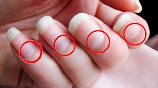 13 Health Problems the Moons on Your Nails Warn You About