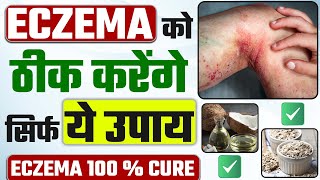 How to cure eczema permanently home remedies | Eczema ka gharelu upay | एक्जिमा का इलाज