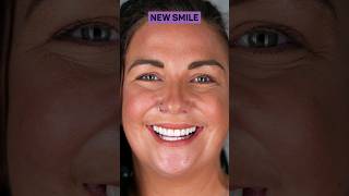 Crystal's Before and After New Smile Transformation with Porcelain Veneers!