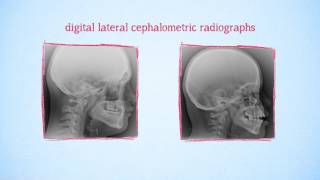 Infographic - Craniofacial growth and hypodontia in Down Syndrome