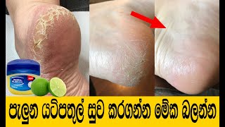 පැලුන යටිපතුල් දින කිහිපයකින් සුව කරගන්න | Cracked Heels Home Remedy | Yatipathul palenawata beheth