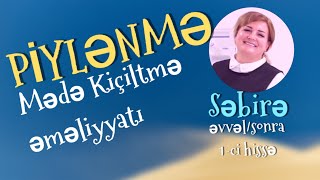 Piylənmə və mədə kiçiltmə, əvvəl/sonra, 1-ci hissə #aslanabdulla 0505508882