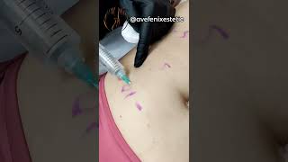 Hidrolipoclasia o Lipo sin bisturí excelente para rebajar grasa localizada #avefenixestetic