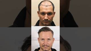 TOP 5 natürliche Haartransformationen