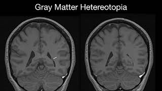 Gray matter Heterotopia