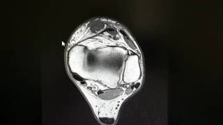 Anterior Tibial Tendon Rupture as seen on an MRI