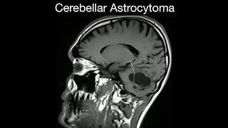 Cerebellar Astrocytoma