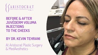 Before & After Juvéderm Voluma Injections Long Island, New York by Dr. Kevin Tehrani