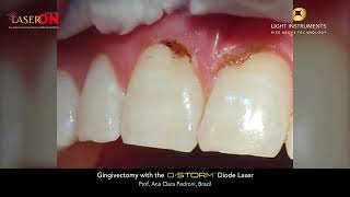 Gingivectomy with the D-Storm™ Diode Laser