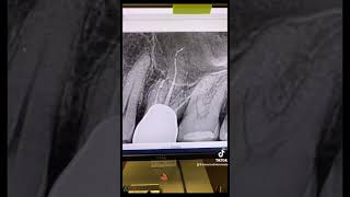 RCT of a calcified tooth #14 through a crown in one appointment. #rct #rootcanal #eighteeth