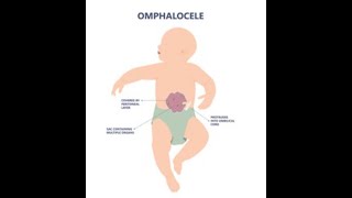 MRCOG part 3 | counselling for Exomphalos