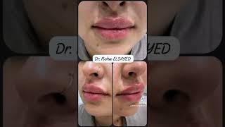 Lip filler 💗💗💗 #فيلر_الوجه #rejuvenation #البلازما #بوتكس #خيوط #نضاره_البشره