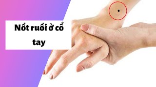 Xem bói ý nghĩa nốt ruồi ở cổ tay Trái, Phải ở Nam, Nữ có giàu không?