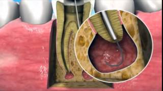 Nonsurgical management of periapical lesions