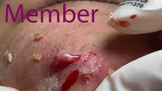 Acne Treatment Huong Da Nang# 024 |  fans membership