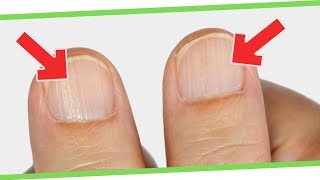 What Ridges In Finger And Toenails Mean For Your Health