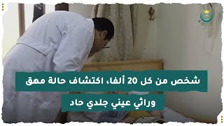 شخص من كل 20 ألفا، اكتشاف حالة مهق وراثي عيني جلدي حاد