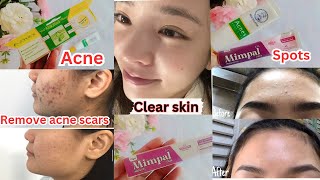 Remove Acne, pimples,Acne Scars|Get Clear Skin|Remove Acne Scars