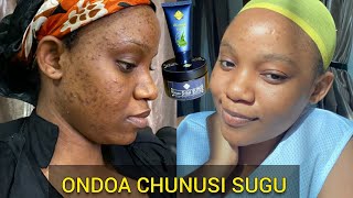 Kuondoa CHUNUSI na MAKOVU Usoni Kwa Haraka | How to get rid of acne in a week | Real results