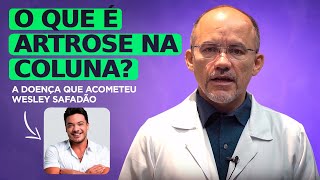 O que é Artrose na Coluna? Neurocirurgião Explica!