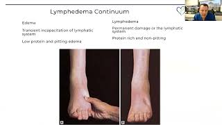 Lymphedema Fellowship Lecture | Grand Rounds 3.10.2023